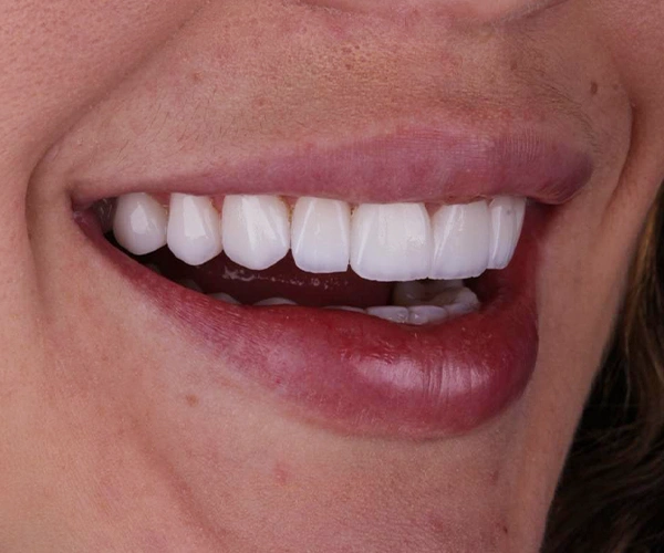 Facetas de Porcelana - VIP Smile