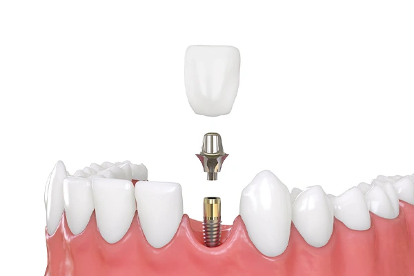 Implante Unitario - VIP Smile