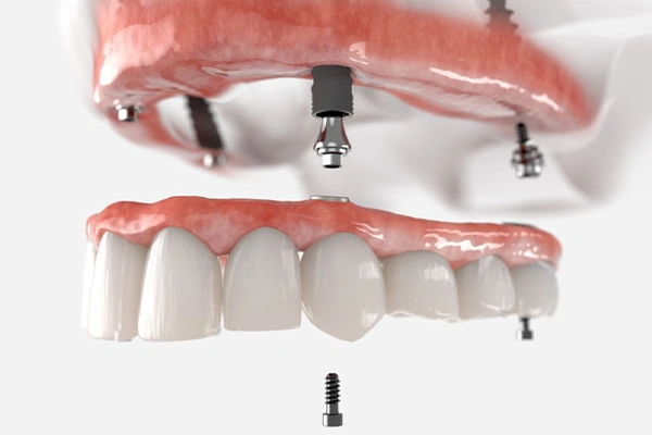 Protocolo sobre Implantes - VIP Smile